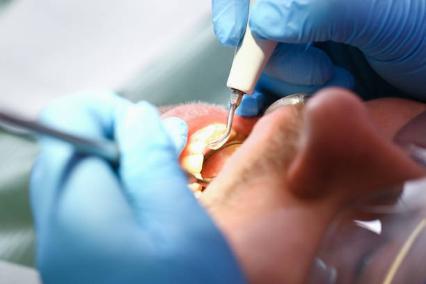 Best Emergency Dentist for Lost Fillings or Crowns in Emmett, ID
