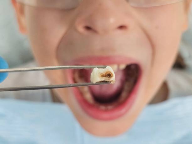 Best Emergency Dentist for Knocked-Out Tooth in Emmett, ID